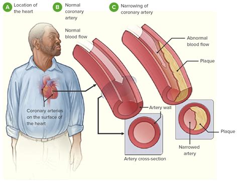 Coronary Heart Disease | Concise Medical Knowledge