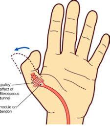 Pin on Arthritis: The Facts | Oh My Arthritis