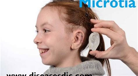 Microtia – Causes, Treatment, and Complications.