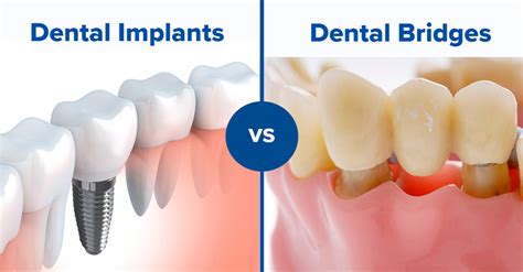 Absolute Dental Blog | Implants or Bridges - What’s Better?