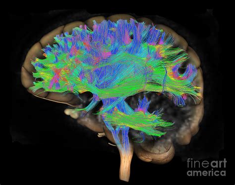 Brain, Fiber Tractography Image #8 Photograph by Scott Camazine - Pixels