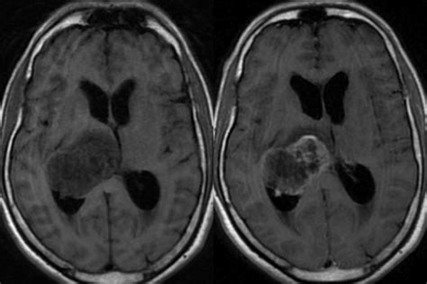 Glioma: Thalamic Glioma