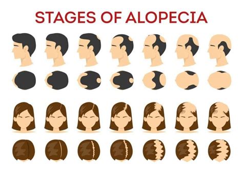 Stages of Alopecia - HealthGardeners