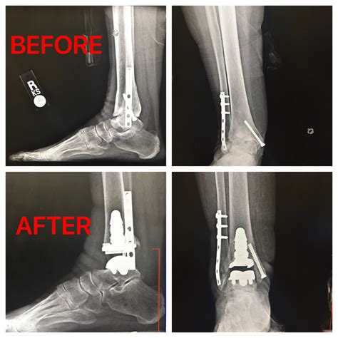 Patient Success Story: Total Ankle Replacement | The Orthopaedic Group, P.C.