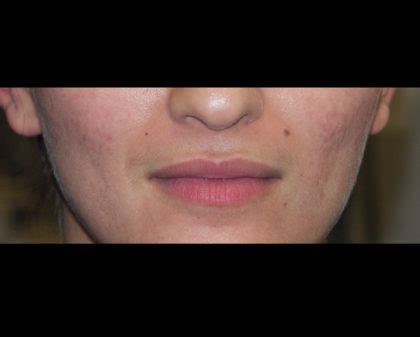 Patient #4387 Juvederm Volbella Before and After Photos Phoenix ...