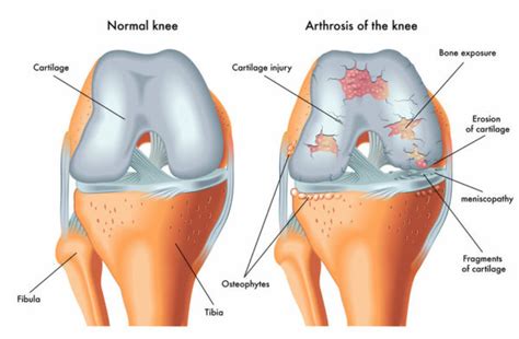 Knee Arthritis - Lyndon Bradley