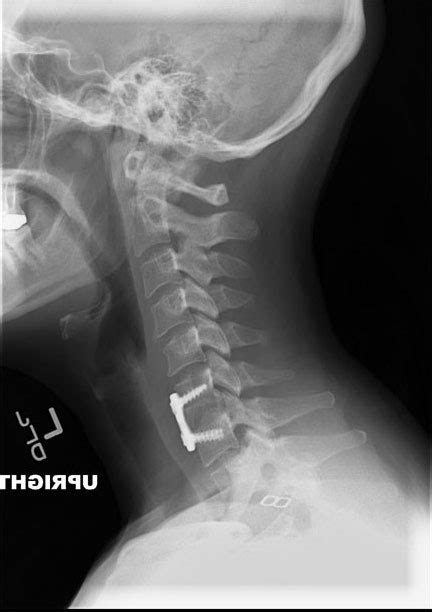 Anterior Cervical Decompression & Fusion (ACDF) | Spine Surgeon