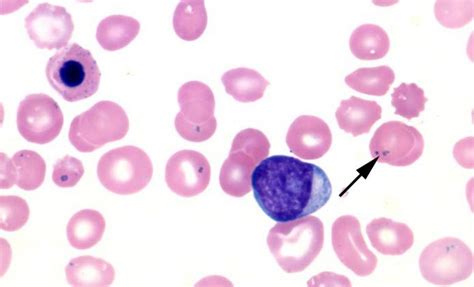 Pappenheimer bodies VS Howell-Jolly bodies Differentiation | Medical ...