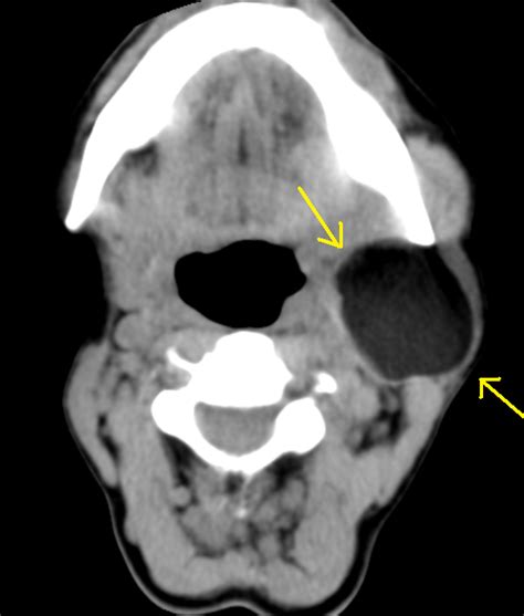 Parotid Lipoma-CT - Sumer's Radiology Blog