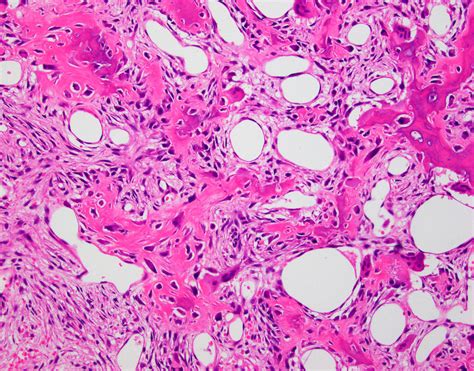 Osteoid Osteoma Histology