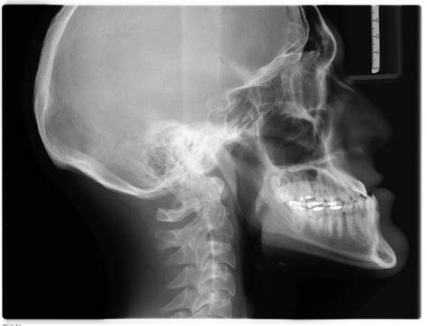 Jaw clicking (TMJ popping) causes and management