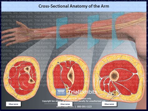 Cross-Sectional Anatomy of the Arm | Trial Exhibits, Inc.