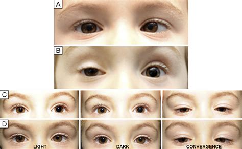 Tonic pupil after botulinum toxin-A injection for treatment of esotropia in children - Journal ...