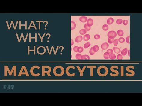 Macrocytosis - WHAT is it, WHY is it (Causes), HOW to investigate | RAPID OVERVIEW OF ...