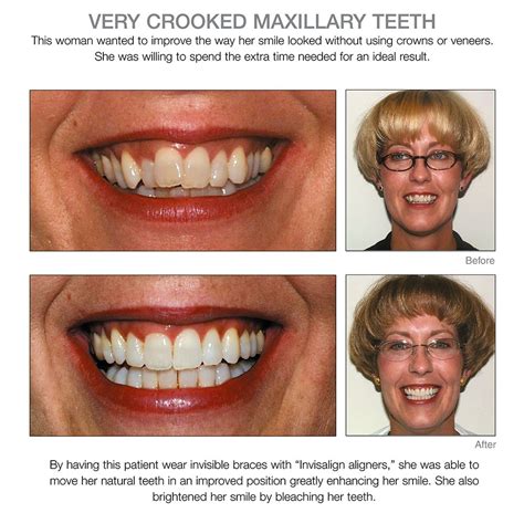 Porcelain Veneers For Crooked Teeth Before And After - TeethWalls