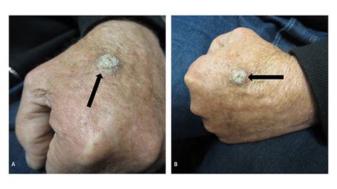 Cureus | Cutaneous Squamous Cell Carcinoma Masquerading as a Verruca: Case Report and Literature ...