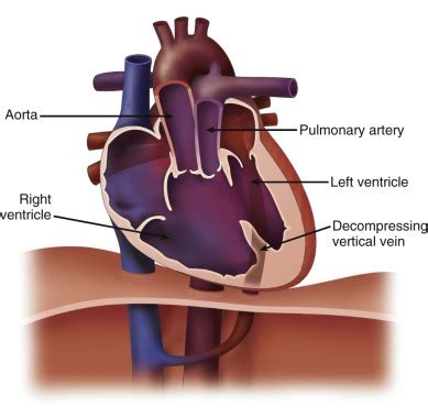 Heterotaxy Syndrome and Complex Single Ventricle | Radiology Key