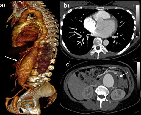 Imaging aortic aneurysmal disease | Heart