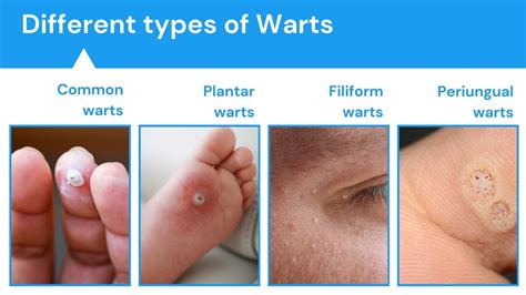 Warts - Causes, Symptoms, Diagnosis, and Treatment