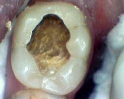 Tooth Decay. Signs and Symptoms