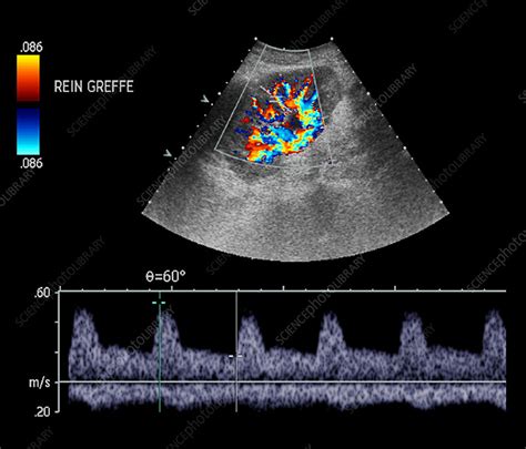 Transplanted kidney, doppler ultrasound - Stock Image - M195/0143 - Science Photo Library