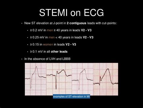 Stemi criteria