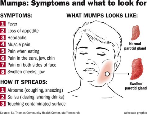 Number of mumps cases in Louisiana rises to 30, centered on college ...