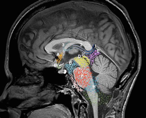 Sagittal midline of the brain: normal anatomy | Radiology Case ...