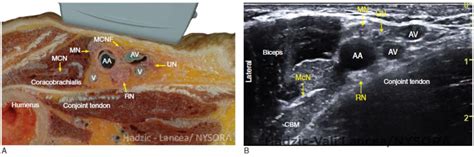 Ultrasound-Guided Axillary Brachial Plexus Block - NYSORA The New York School of Regional Anesthesia