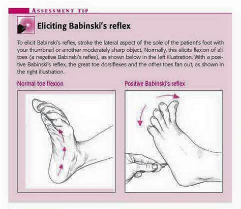 Babinski Reflex/ Plantar Reflex. The Babinski reflex occurs after the ...