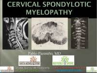 Cervical Myelopathy - Physiopedia