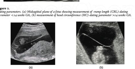 Assessment of chorionicity. (a) Lambda sign-DCDA twins, (b) T sign-MCDA... | Download Scientific ...