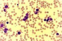 Leukemia, Neutrophilic, Chronic; Neutrophilic Leukemia, Chronic