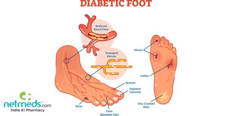 Diabetic Foot Infection: Causes, Symptoms and Treatment