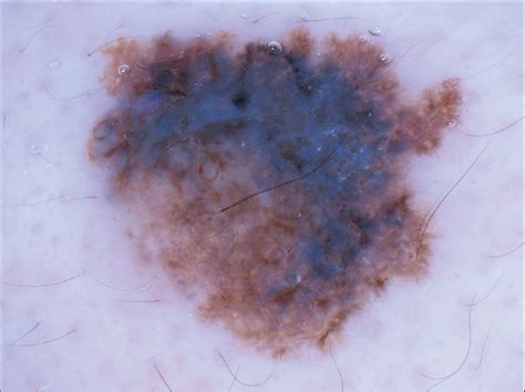 Melanoma arising from the epidermis overlying an acquired intradermal ...