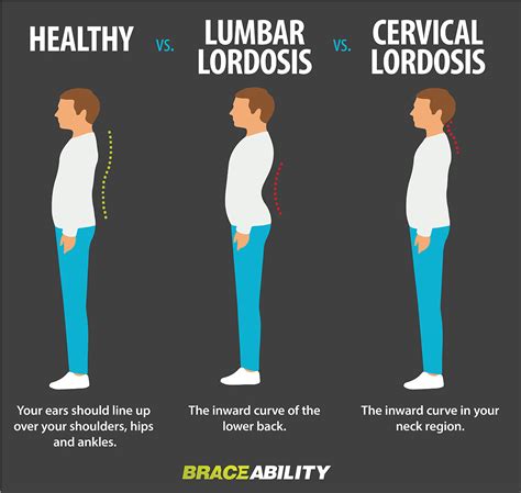 What is Lordosis? Lumbar & Cervical Spine Swayback Symptoms & Causes