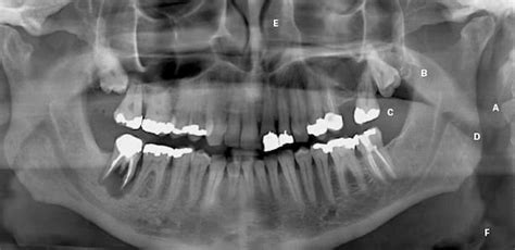 Tooth Abscess: Symptoms, Causes, and Treatment | ILAJAK Medical