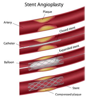 Artery Treatments