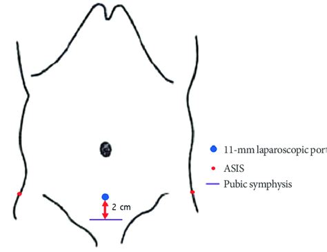 Port placement procedure. ASIS, anterior superior iliac spine. | Download Scientific Diagram