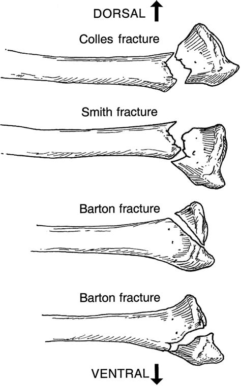 Closed Reduction Distal Radius Fracture