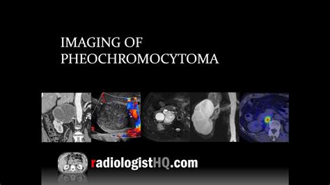 Imaging of Pheochromocytoma - YouTube