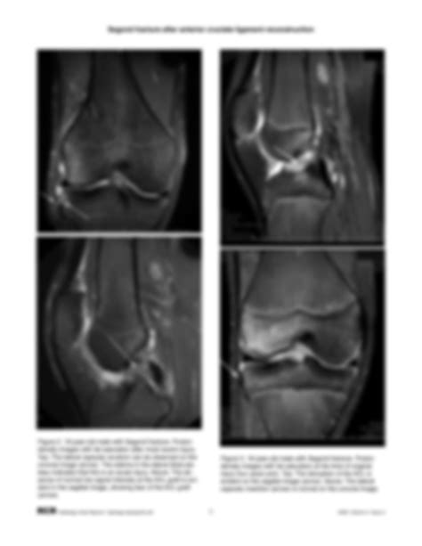 SOLUTION: Segond fracture after anterior cruciate ligament reconstruction - Studypool