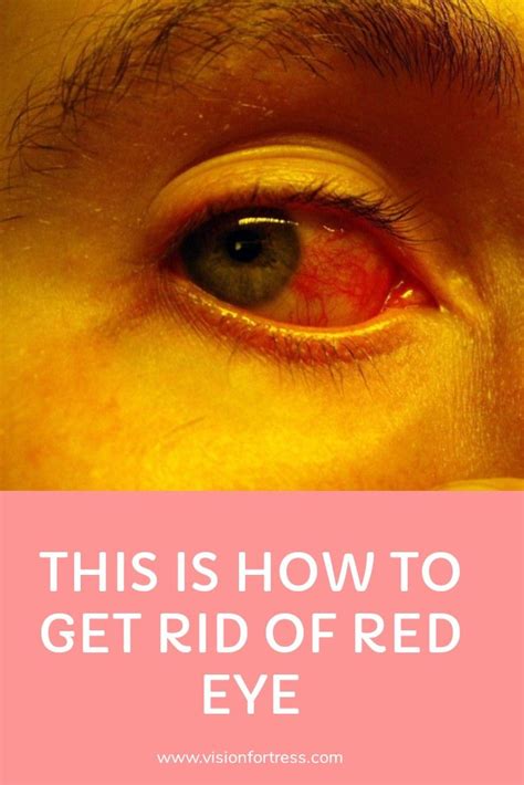 How to get rid of red eye | Eye health, What causes red eyes, Red eye causes