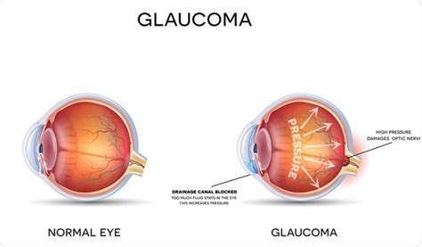 Ocular Hypertension: Diagnosis and Treatment