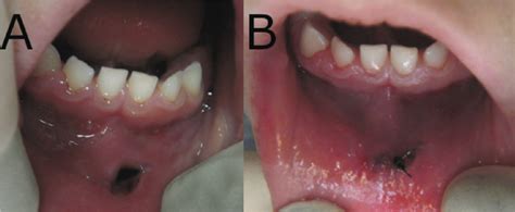 Laceration on the internal side of the lip in a 5-year-old patient ...