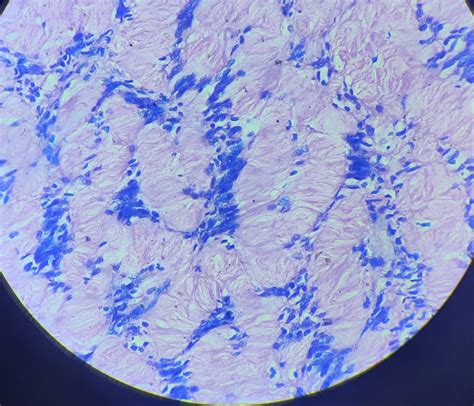 AXILLARY MASS BIOPSY