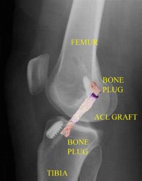 Anterior Cruciate Ligament (ACL) Surgery of the Knee - Chiropractor ...