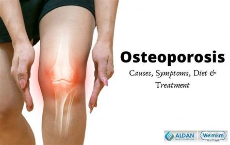 Osteoporosis Treatment, Causes, Symptoms, Diet & Prevention