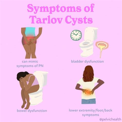 Tarlov Cysts Demystified: What You Need to Know | PHRC