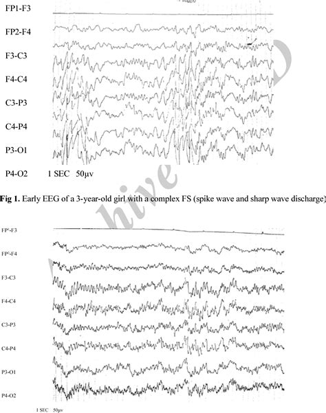 [PDF] The Best Time for EEG Recording in Febrile Seizure | Semantic Scholar